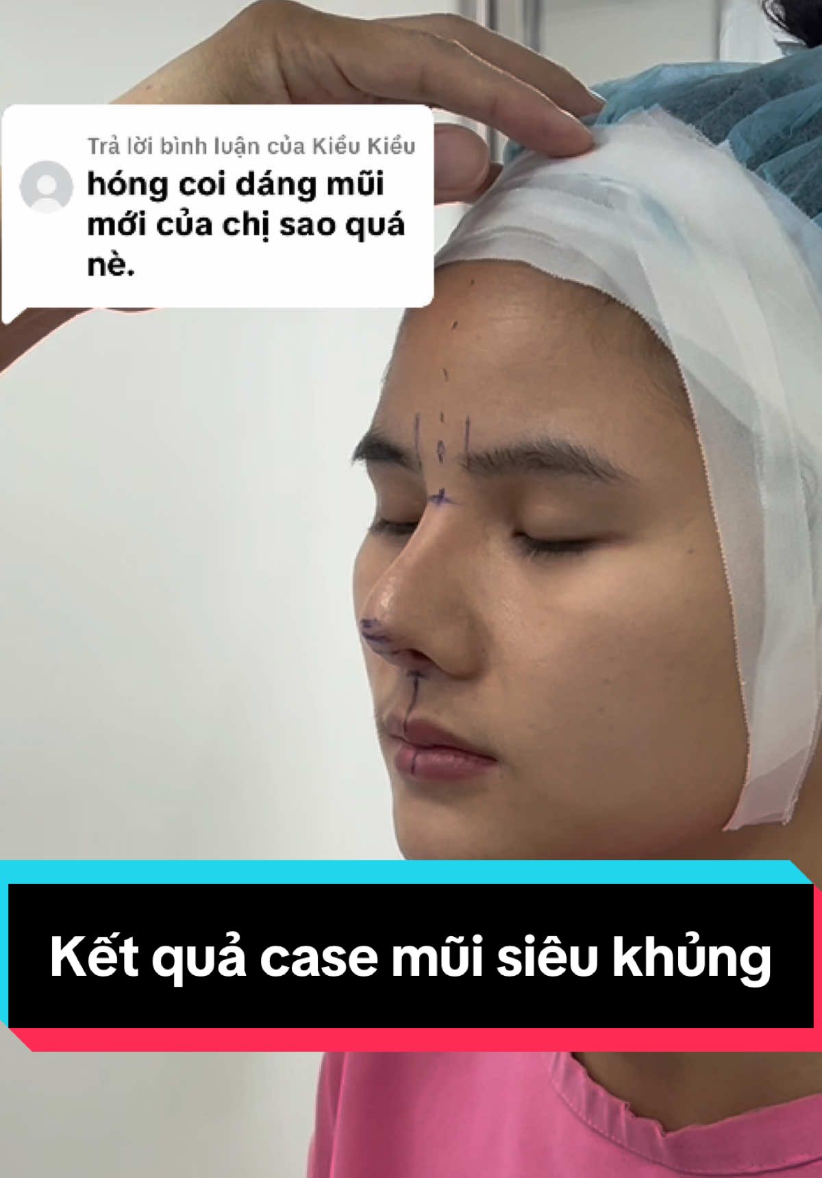 Trả lời @Kiều Kiều  kết quả đây nhé 🥰🥰#thammy #viral #nangmui #xuhuong #nose 