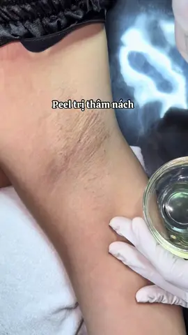 Nách thâm không còn là vấn đề nhé khách ơi #peel #peelnach 