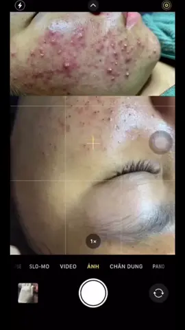 #gomcoimunsau3den10ngay 