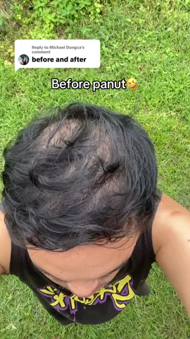Replying to @Michael Dungca ito sir before and after ko #hairgrowth #hairgrowthjourney #hairgrowthtips #minoxidil #fyp 