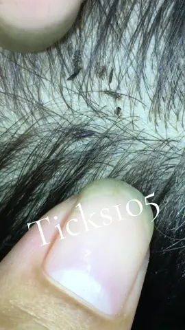 Remove lice #😭😭😭 #😱😱😱omg #liceremoval #🥶🥶🥶 #like 