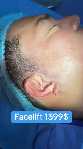 #surgery #operation #facelift #cangdamat #thammy 