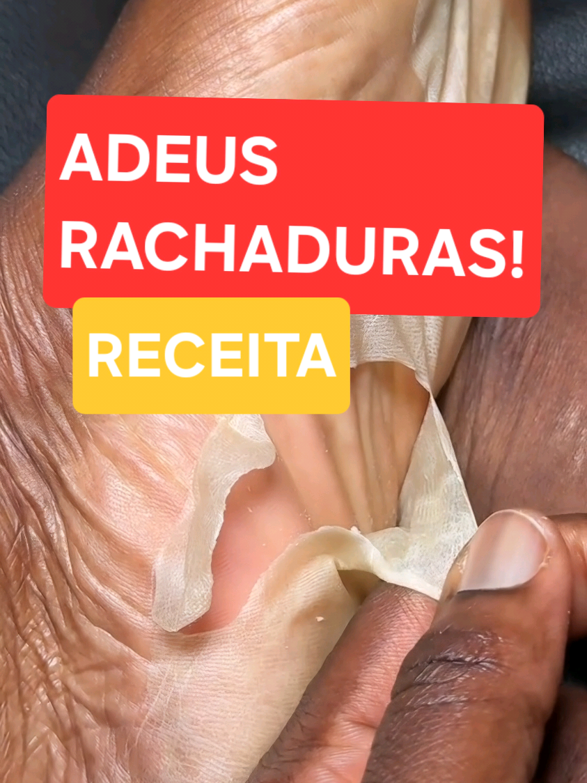 Pés rachados receita! #dicadesaude #dicadebeleza #pés #rachadurasdecalcanhar #rachaduraspés 