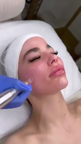 #microneedling #bbglow #skincare #dubai #facial 