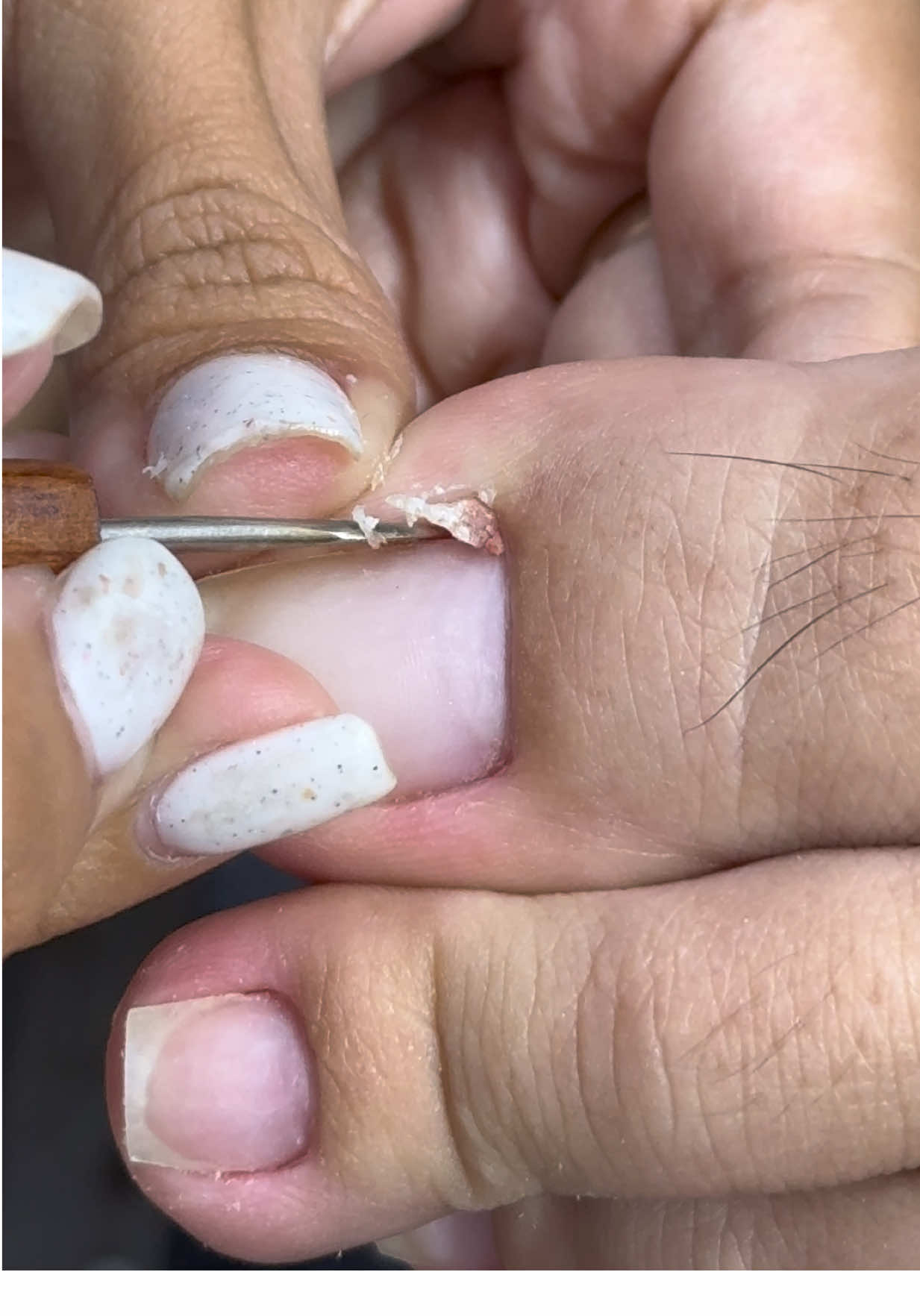 Nhẹ nhàng vậy thôi #lấykhoémóng #laykhoemong #lấy_khoé_chân #lấy_khoé #khoéchân 