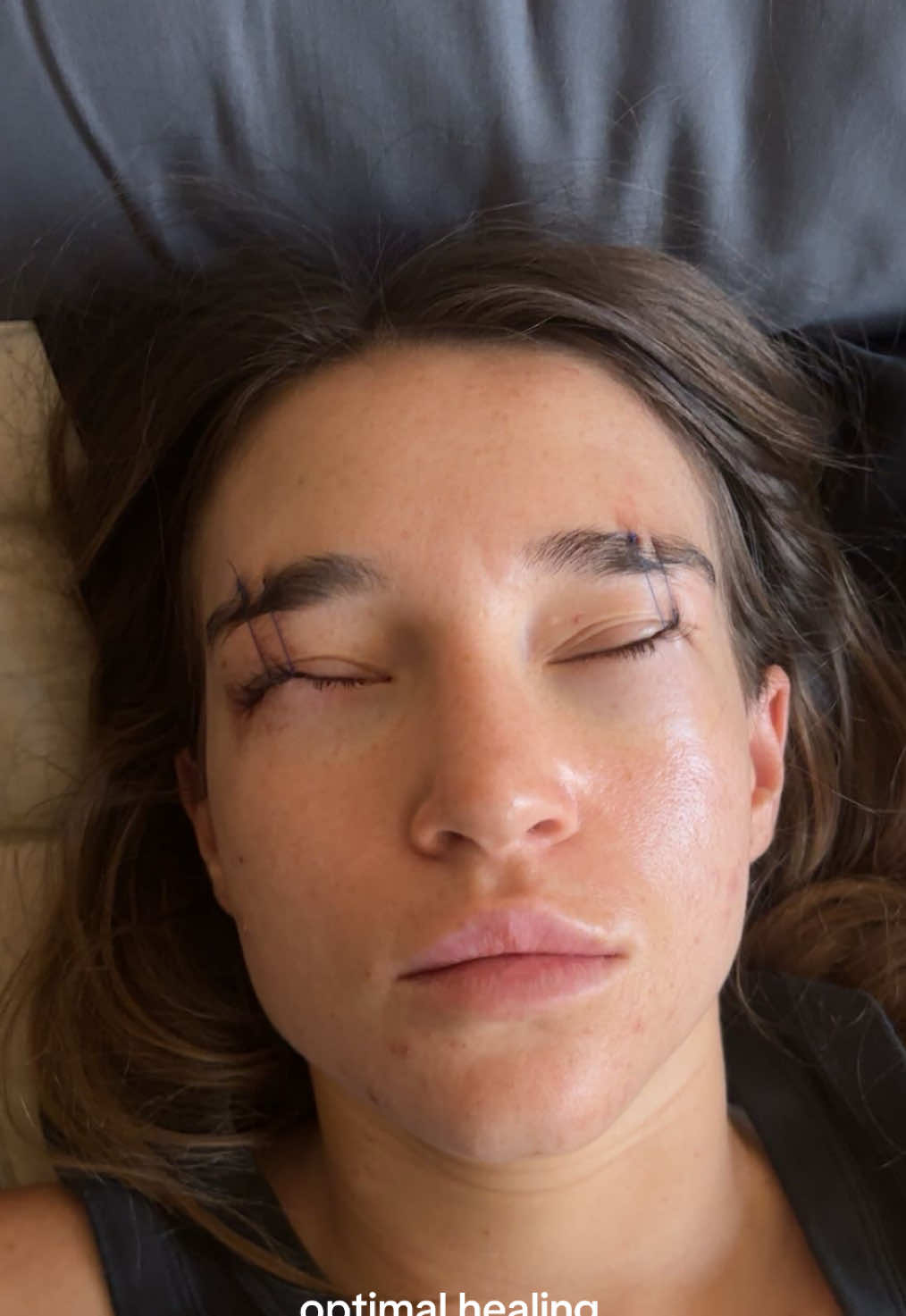 horror movie Lore #lowerbleohtoplasty #eyebags #plasticsurgery #eyebagsurgery #eyebagremoval #plasticsurgeryreveal 