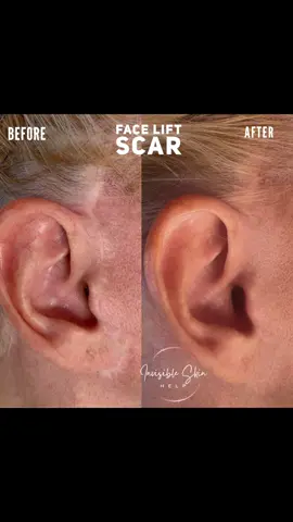 Face Lift Scar #CapCut 