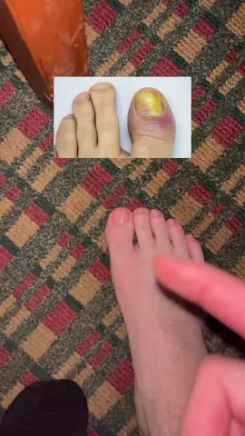 The were so bad  #lunavia #antifungal #toes #grossfeet 