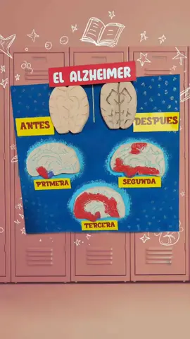 Maqueta del Alzheimer #alzheimer #maqueta #cerebro #medicina 