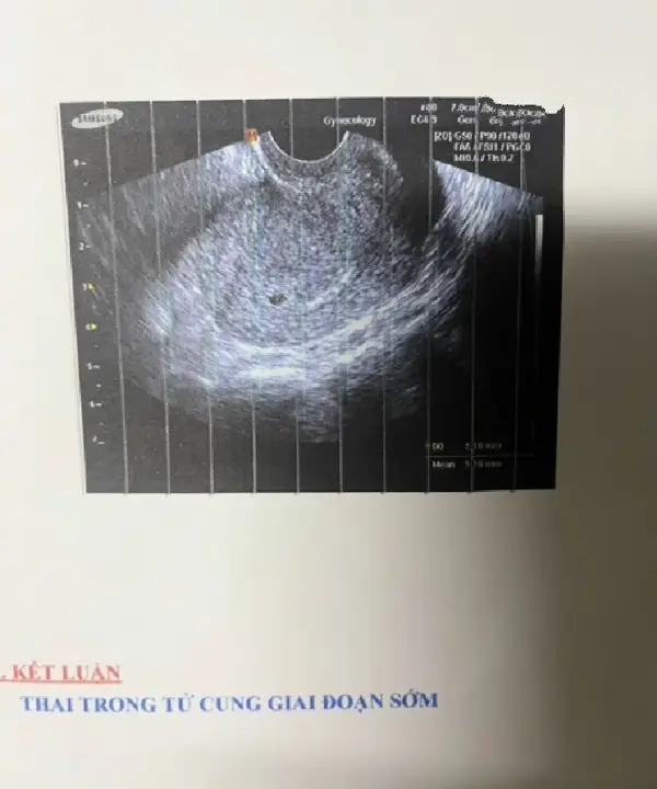 Gửi đến em bé của mẹ... Mẹ đã từng nghĩ,chỉ cần yêu thương con đủ nhiều thì dù có một mình, mẹ cũng sẽ cố gắng để giữ con lại bên đời. Nhưng có những điều...đau đến mức không thể nói thành lời. Mẹ biết đến sự hiện diện của con chỉ chưa đầy 3 tháng - quá ngắn để chuẩn bị,quá dài để thương.mẹ vẫn còn nhớ như in giây phút nhìn thấy hai vạch đỏ trên que thử... mẹ vừa run, vừa khóc, vừa đặt tay lên bụng thì thầm: