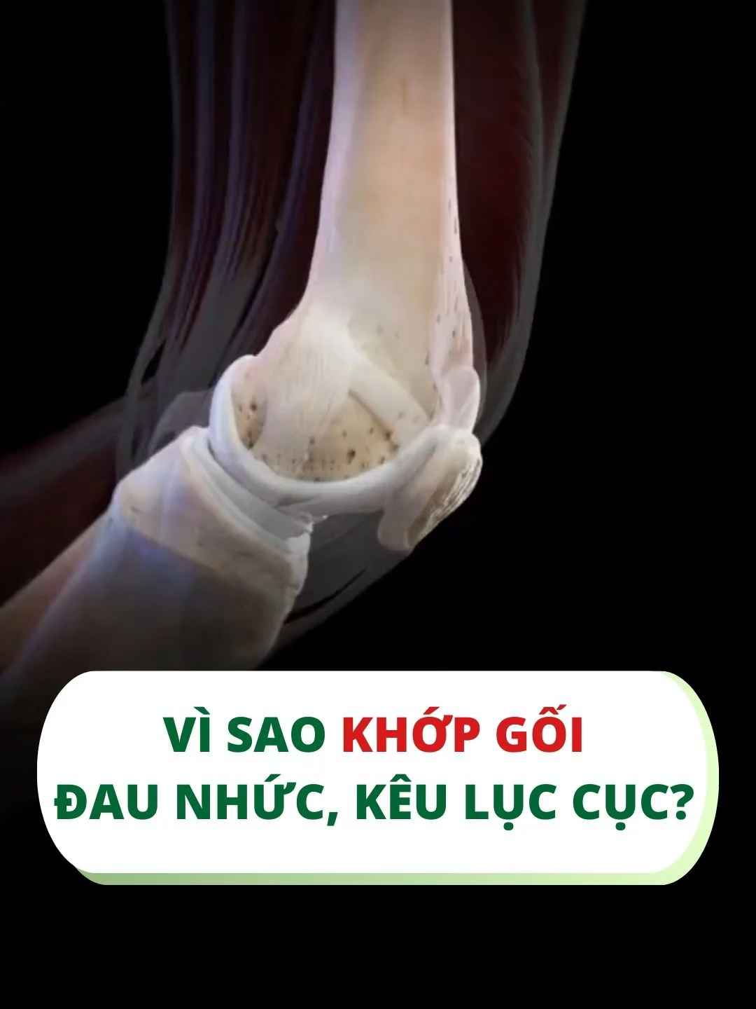 Hãy quan tâm đến khớp gối của bạn nhiều hơn nhé #wealthyhealth #suckhoe #thoaihoakhop #xuongkhop #sunkhop