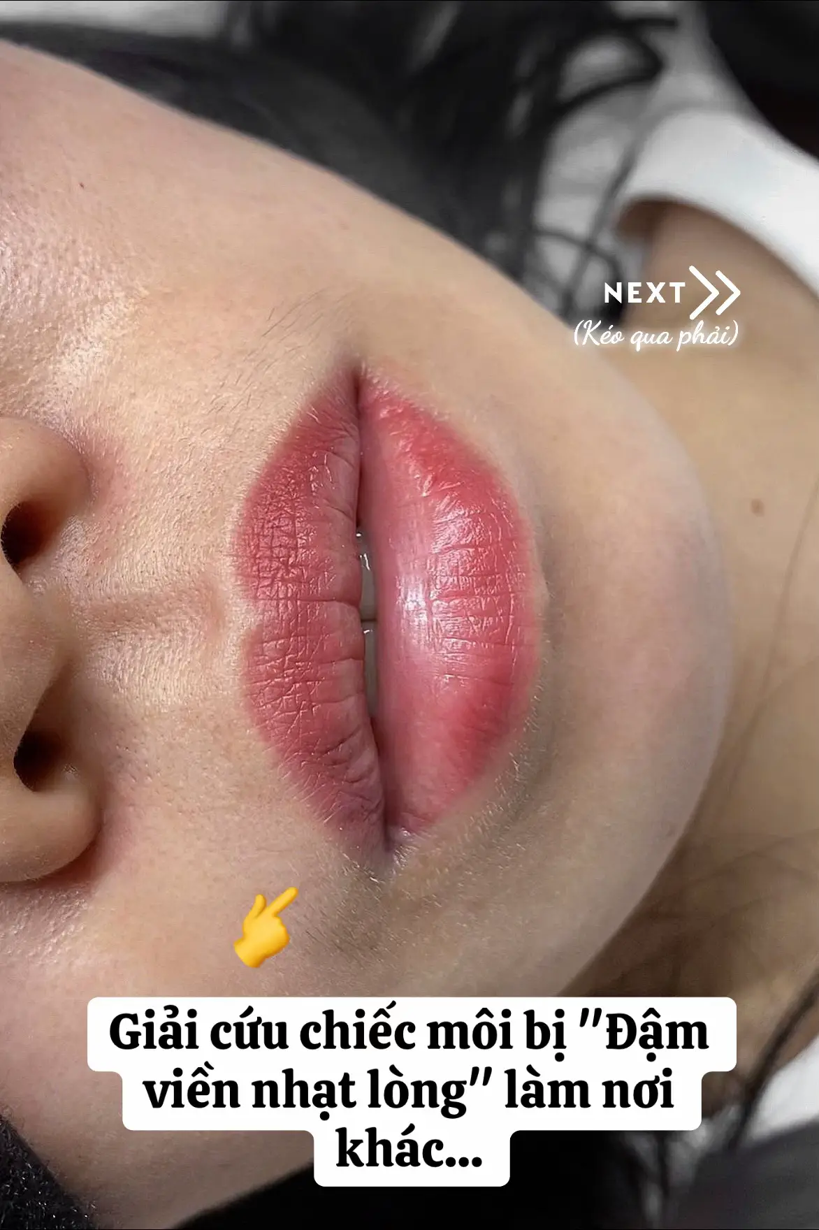 #môisaubong #phunmôiđẹpsàigòn #sửamôihỏng #thươngabby #khửthâmmôi 