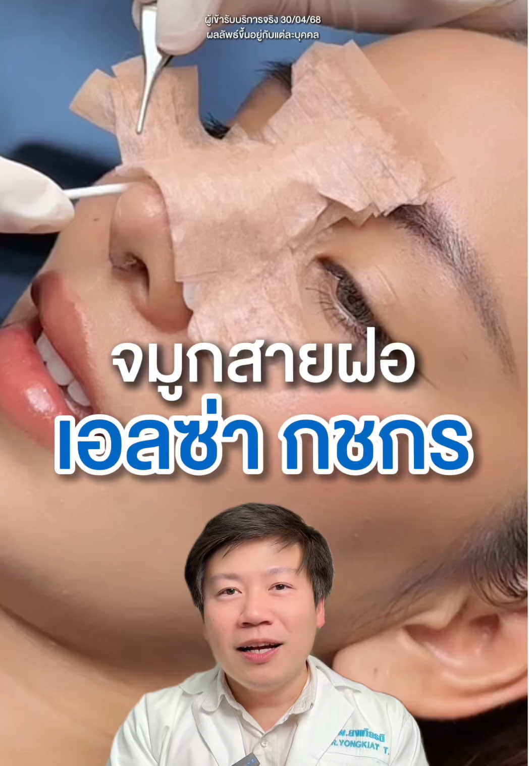 จมูก เอลซ่า กชกร ทำไมถึงได้เป็นทรงนี้!! . #รีวิวหมอกายslc #รีวิวศัลยกรรมslc  #รีวิวเสริมจมูกslc #slchospital #idolnoseandeyesbyslc 