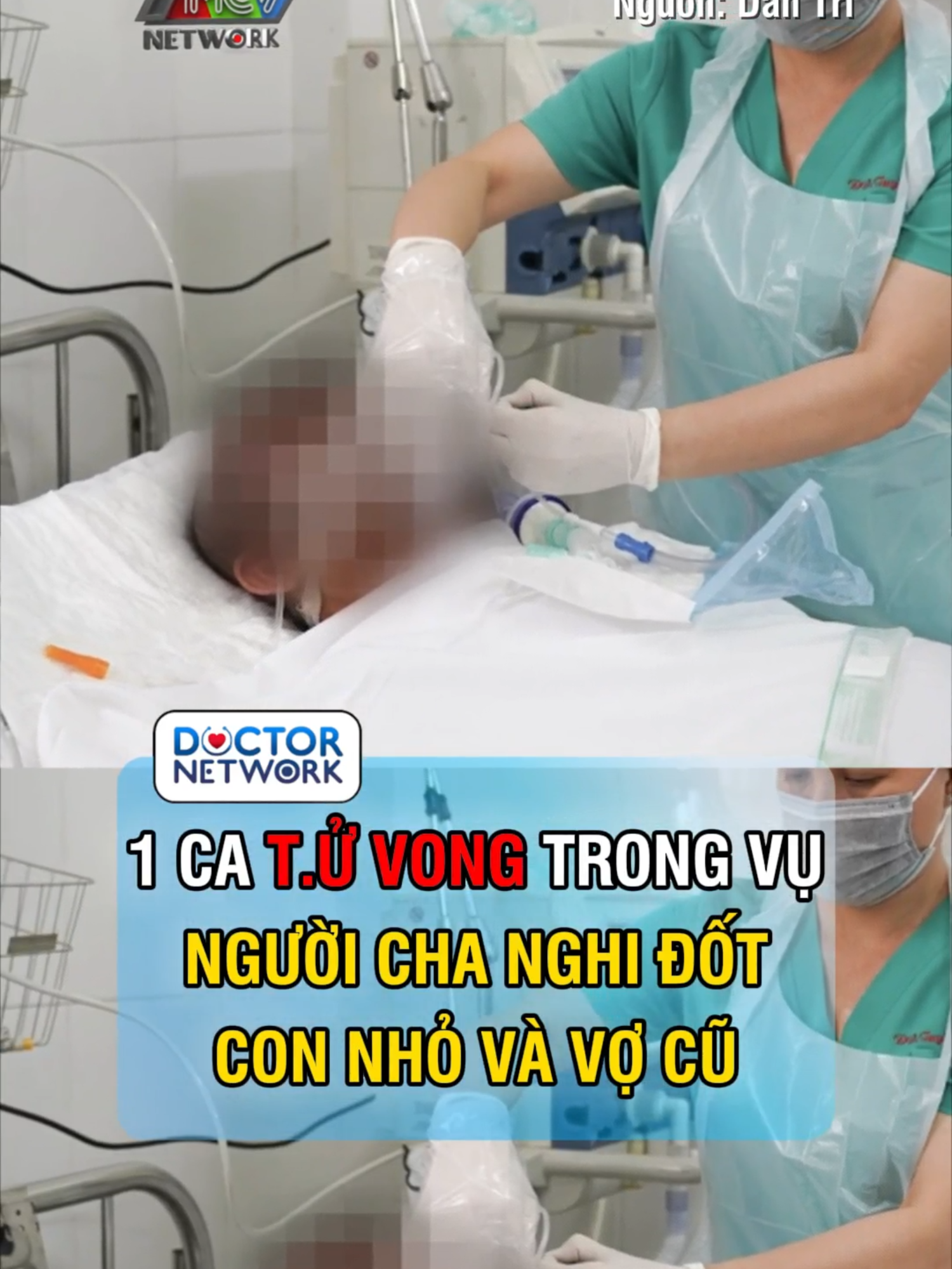 Vụ người cha nghi tưới xăng đốt vợ cũ và 2 con nhỏ: Một người tử vong TPHCM – Sáng 25/8, Bệnh viện Chợ Rẫy xác nhận ông T.K.Đ. (37 tuổi), người liên quan đến vụ phóng hỏa khiến vợ cũ và hai con nhỏ bỏng nặng tại Tây Ninh, đã tử vong do vết thương quá nặng. Ông Đ. mất lúc 1h sáng cùng ngày tại khoa Bỏng – Phẫu thuật tạo hình sau 4 ngày điều trị tích cực. Trước đó, ông được chẩn đoán bỏng xăng 77% diện tích cơ thể, kèm bỏng hô hấp và sốc bỏng nặng. Hiện, bà N.T.H. (32 tuổi, vợ cũ ông Đ.) vẫn đang được các bác sĩ khoa Săn sóc đặc biệt điều trị trong tình trạng nguy kịch với bỏng sâu 74% cơ thể, tổn thương hô hấp và sốc bỏng. Hai con nhỏ của họ – bé trai 5 tuổi và bé gái 13 tuổi – đang được điều trị tại Bệnh viện Nhi đồng Thành phố. Cả hai đều bị bỏng rộng, tổn thương đường hô hấp, nguy cơ nhiễm trùng và biến chứng nặng, trong đó bé trai 5 tuổi nguy kịch hơn cả. Theo Báo Dân Trí #MCV #MCVTV #DoctorNetwork #BacSiNoiGi #vietnamtopnews #tintuc #tintucyte #tinmoi #tintuc24h