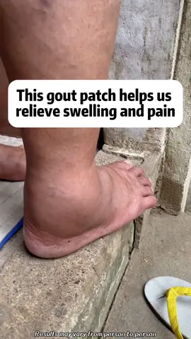 Say goodbye to back pain and muscle strain with the powerful DRMITSUI Bone Pain Patch! Formulated with soothing MSM, emu oil, safflower, and turmeric, it helps repair damaged lower back joints, relieve back pain, and restore lower back strength and flexibility.#GoutPatch #GoutRelief #JointCare #HealthyLiving #wy
