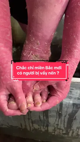 Chắc chỉ có miền Bắc mới có người bị vẩy nến thôi ?@Thị Tuyến DC 35(2) #vaynen #viemdacodia #viemnanglongviemlochanlong 
