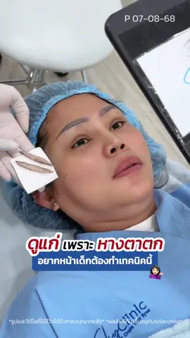 ดูแก่‼️ เพราะหางตาตก อยากหน้าเด็ก ต้องทำเทคนิค #subbrowlift #ซ่อนแผลใต้คิ้ว #skyclinic #หมอสกาย #ทำตาที่ไหนดี 