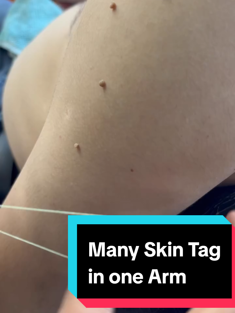 So many Skin Tags in one Arms Buy a cream if this is pain  #skintag #kulit 