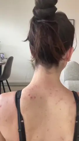 Bị mụn lưng có thể tham khảo loại này nha các mom #munlung #xitmunfreeskin #xuhuong #goclamdep #viemnanglong 