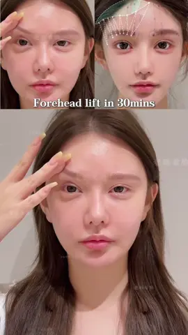 ✨ A refreshed look starts from the top ✨ Our forehead lift smooths lines, lifts the brows, and opens up the eyes—making your whole face look more youthful and energized. Subtle changes, big impact.  #ForeheadLift #BrowLift #FacialRejuvenation #YouthfulLook #NaturalBeauty    