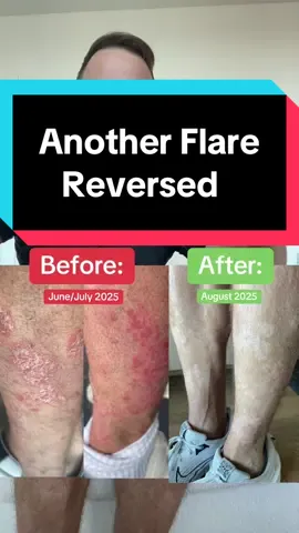 Look at this healing transformation #psoriasis #skincare #HealingJourney 