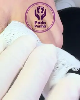 Esses dedinhos incomodam demais!! #unhaencravada #podologia #mulheres #homens 