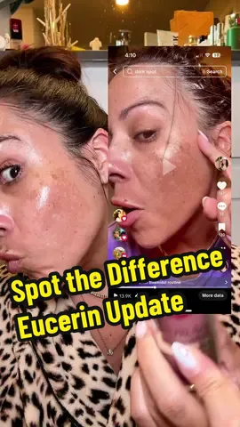 Two weeks into using the Eucerin Radiance Dual Serum and I’m seeing real results 🌟. My melasma and dark spots are visibly lighter—one spot in particular has faded noticeably—and overall my skin looks brighter and more even-toned. The serum combines Thiamidol (a patented anti-pigment ingredient) with Hyaluronic Acid, working together to reduce hyperpigmentation while improving skin hydration. Consistency + SPF = key. Linking the dual serum if you’ve been looking for something that clinically targets dark spots and discoloration. #melasma #darkspots #hyperpigmentation 