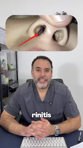 Qué es la rinitis alérgica y porque te puede dar rinitis alérgica? #pediatra #pediatria #rinitisalergica #rinitis 