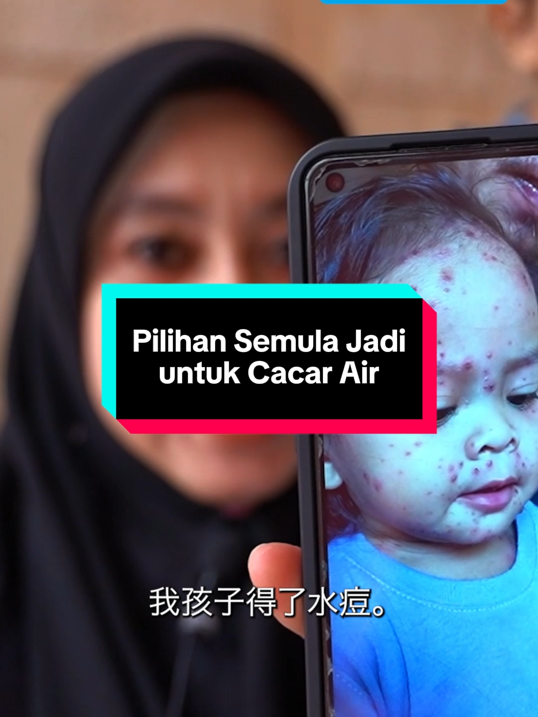 Dulu chickenpox penuh satu badan 😔 Sekarang sembuh tanpa parut 💧✨ Rahsia? Minum air hidrogen sahaja! #Hydromi #HydrogenWater #Elken #thescienceofhydrogen