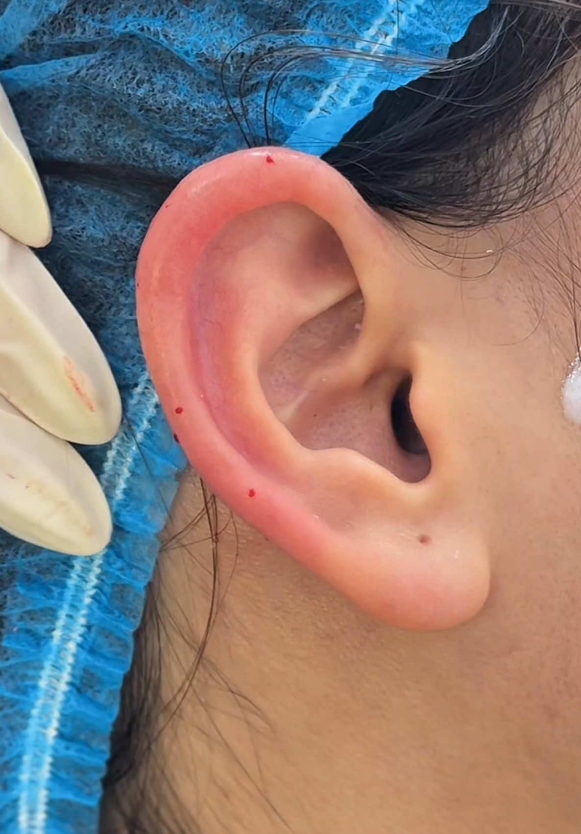 Ti.em tai tài lộc quan 9 thu duc #tiemfillerthuduc #tiemfillerquan9 #haiyenbeauty #tiemtaitailoc #tiemtai 