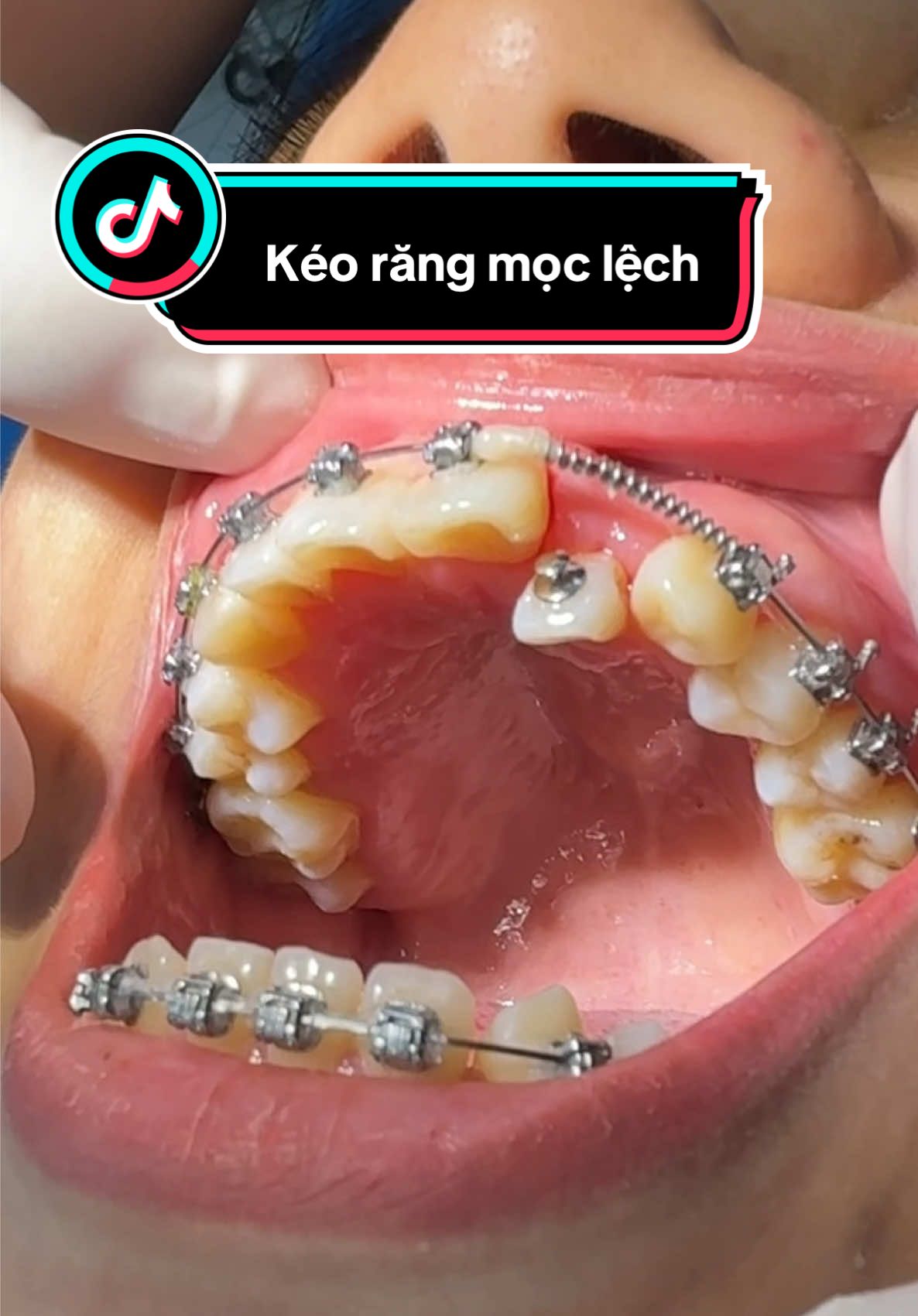 Răng số 2 mọc lệch trong rất thường gặp , kéo nó ra thôi nào ! #nhakhoa #niengrang #fyp #xuhuong #chinhnha 