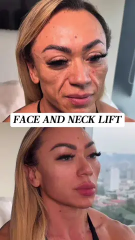 “Every year, I feel like gravity is winning…” The mini-incision SMAS lift reverses sagging at its root by lifting the fascia layer. It’s a gentle, lasting way to bring back youthful definition. #SMASLift #Facelift #AntiGravityEffect #NaturalRejuvenation #SaggingImprovement #YouthfulContours