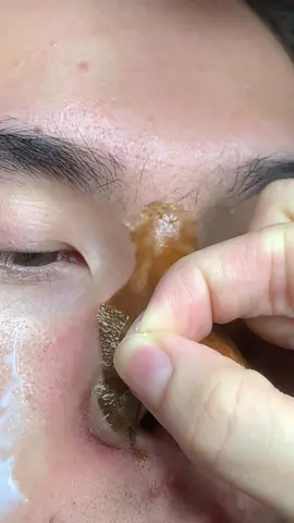 Tê  #chamsocdaseo#chamsocda#chamsocdamun#chamsocdanam#tanbinh      