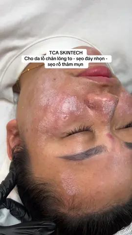 TCA cho da lỗ chân lông to , sẹo đáy nhọn. Điều gì khiến da bong ra từng lớp nhưng lại đẹp hơn gấp bội? #mayspa #tca_skin_tech #peel_lỗ_chân_lông 