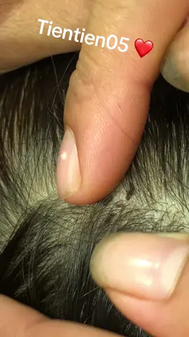 Remove lice #LearnOnTikTok #liceremoval ❤️❤️❤️#omg 🥰🥰🥰