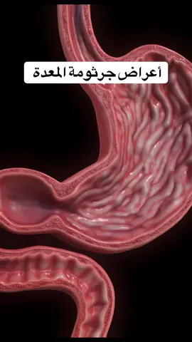 #جرثومة_المعدة #علاج  #أعراض #فوريو  #pourtoi  