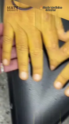 ⚠️ Tap here for the answer! ✅ Spoiler alert: Jaundice Here we can see jaundice of the skin - characterised by deposition of the yellow pigment bilirubin in the tissues. Bilirubin is the breakdown product of heme (in haemoglobin) We can’t possibly say the cause with such limited information but we can categorise jaundice as follows: 🩸Pre hepatic: excess haemolysis/abnormal conjugation - haemolytic anaemia - Malaria - Gilbert’s syndrome - Criggler-Najjar 🍺 Intrahepatic: hepatocellular dysfunction - Hepatitis (viral/ischaemic/toxic) - Alcoholic liver disease - Haemochromatosis - Autoimmune hepatitis 🤚Post hepatic: Abnormal drainage of bile through the biliary system - pancreatic cancer - Cholangiocarcinoma - Primary biliary cirrhosis - Primary sclerosis cholangitis 💡 Asymptomatic jaundice during an acute illness? Consider Gilbert’s disease. 💡 Jaundice in the context of excess alcohol? Think Alcoholic liver disease 💡 Jaundice in the context of T2DM? Think non-alcoholic fatty liver disease. #medical #doctor #medico #nurse #mbbs