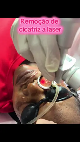 “Cicatriz te incomoda? O laser pode transformar sua pele! ✨ ✅ Reduz a espessura ✅ Suaviza a textura ✅ Melhora a cor e aparência Com tecnologia a laser, o tratamento é seguro, eficaz e com resultados visíveis! 👉 Diga adeus às marcas e recupere sua autoestima. Agende agora e descubra a diferença! #RemoçãoDeCicatriz #LaserCO2 #EstéticaAvançada #PeleRenovada #Autoestima  
