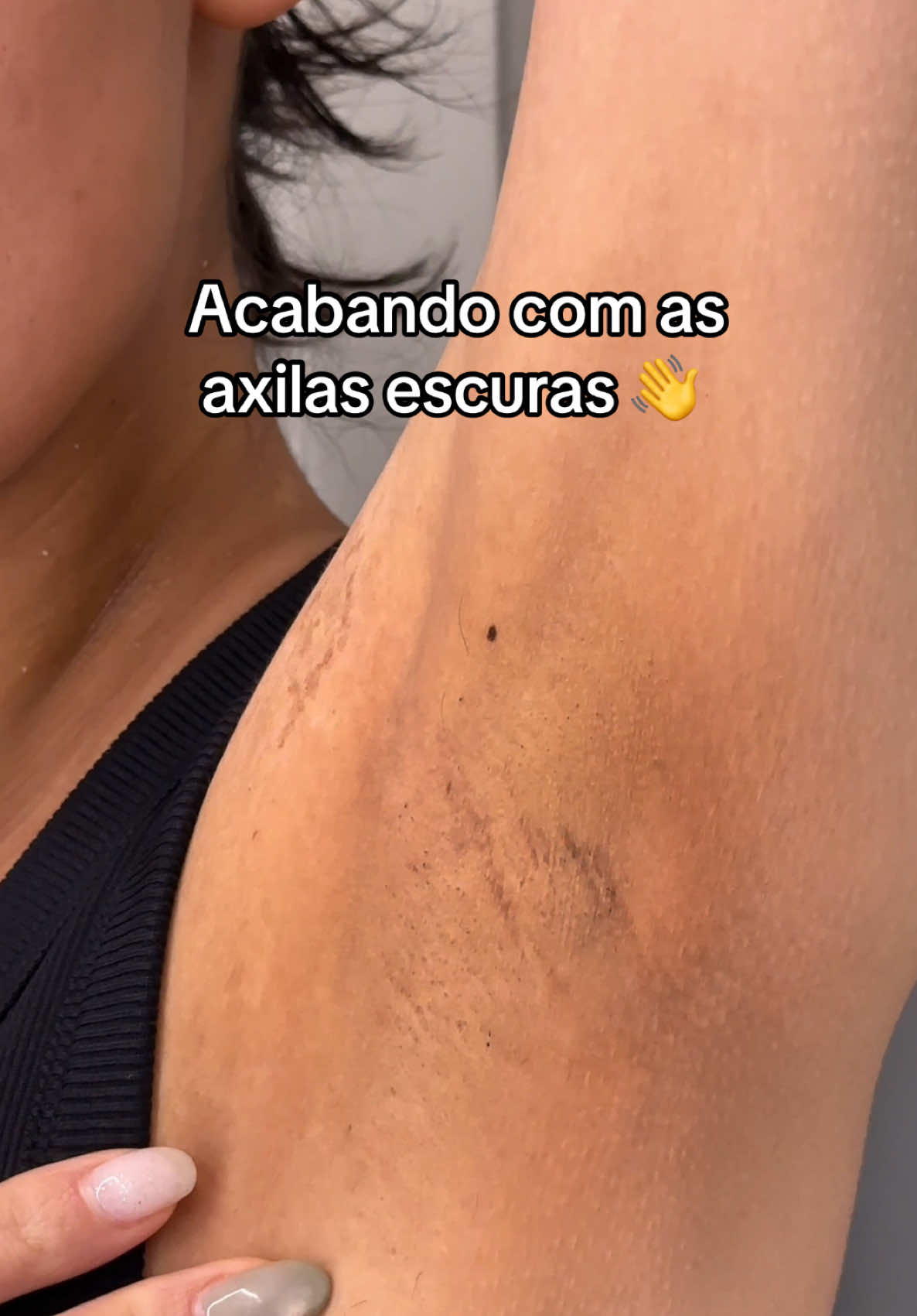 usando serum com ativos incríveis, e na axila também para 👋 axilas escuras! também retinol, muita hidratação e protetor solar! tem na amazon e YesStyle (code: ARIDESU1) @anua_global #axilas #anua #cuidadoscomapele #txa #skincarecoreano 