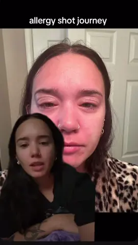 #greenscreen #allergyshots #fyp #xyzcba #allergies 