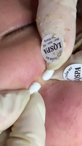 Tăm bông #chamsocdaseo#chamsocda#chamsocdamun#chamsocdanam#tanbinh     