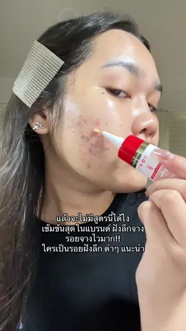 จะไม่มีสูตรนี้ได้ยังไงลดรอยได้ดีขนาดนี้เข้มข้นขนาดนี้ ✅👀  #ลดรอย #ลดรอยซิมไวท์377 #ลดรอยฟาวเดอร์ 