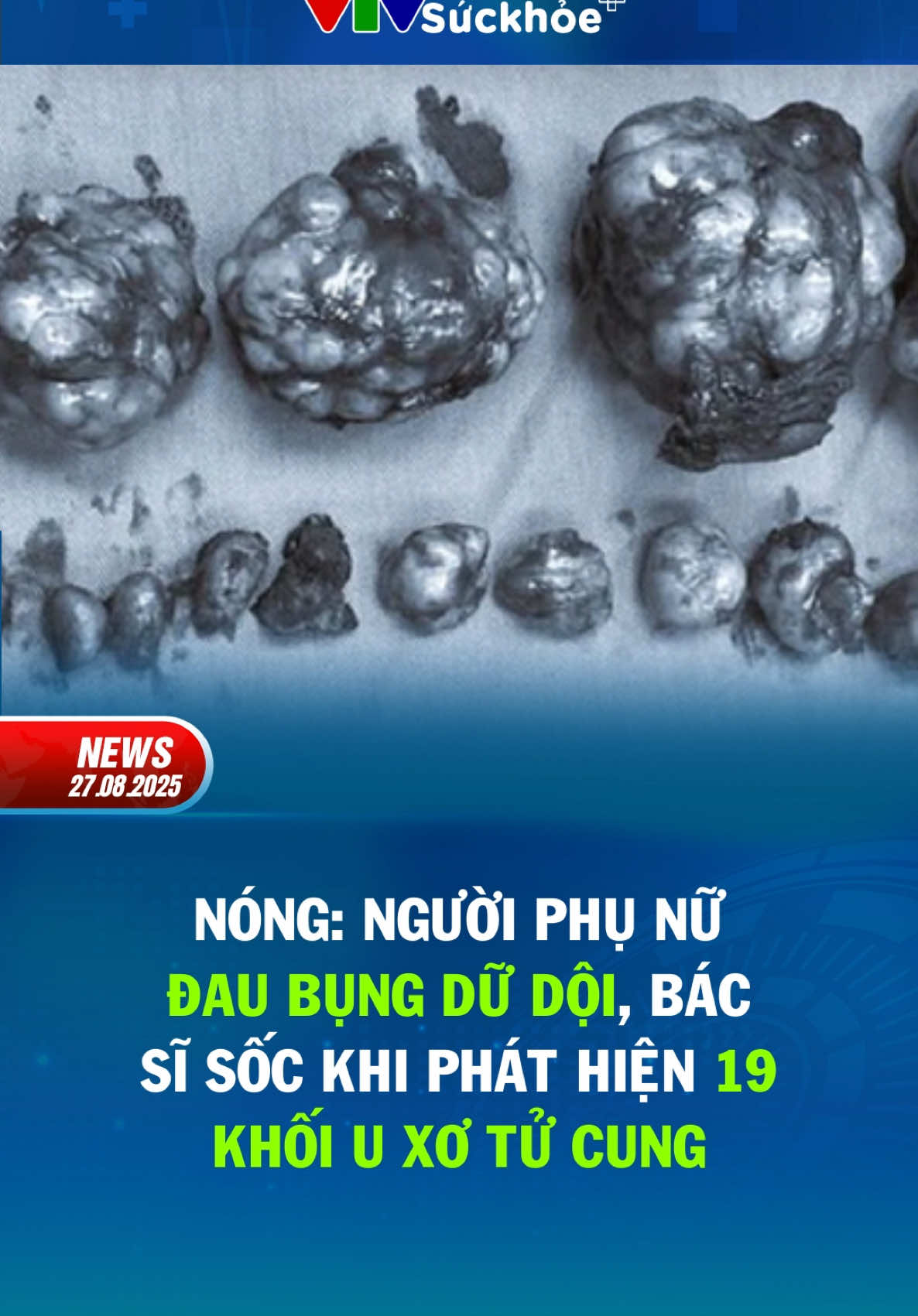 Nóng: Người phụ nữ đau bụng dữ dội, bác sĩ sốc khi phát hiện 19 khối u xơ tử cung #SucKhoe #UngThu #UXoTuCung #BenhPhuKhoa #SucKhoePhuNu #VTVSucKhoe #TinNongSucKhoe #CanhBaoSucKhoe #YHoc #tintuc24h 
