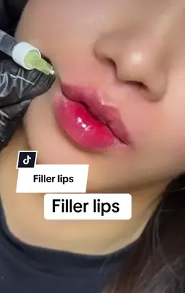 #malaysia #rinoplastia #indonesia🇮🇩 #tiktokmalaysia #viral 