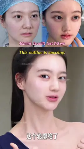 Smooth away deep smile lines with Dr. Xie’s 9D Facelift ✨ Natural lift, youthful look.  ✔️ Lifts sagging midface tissues ✔️ Reduces excess volume if needed ✔️ Restores lost support and tightens skin ✔️ Improves deep nasolabial folds naturally #9Dfacelift #FacialLift #SmileLines #YouthfulFace #FacialRejuvenation  