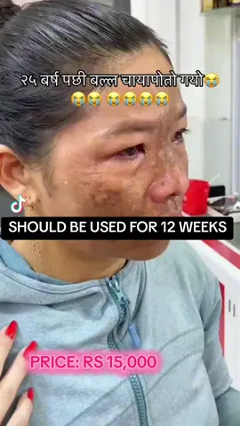 DM FOR PRODUCT. 100% GUARANTEE. RS 15000 FOR 30ML PATENTED PRODUCT चाया पोतो  WHITENING #BEAUTY #skincare #NEPAL #MELASMA #FYP