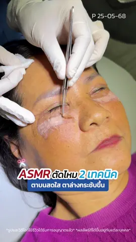 #asmr ตัดไหม 2 เทคนิค ทำทั้งตาบนตาล่าง ‼️😱 #รีวิวตาสองชั้น กำจัดถุงใต้ตาแผลนอก #ตัดถุงใต้ตา #skyclinic #หมอสกาย 