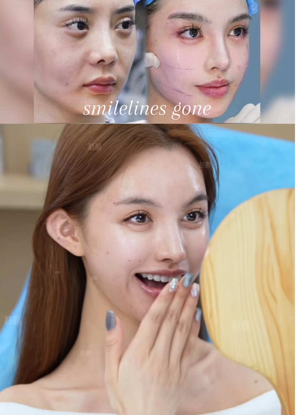 SmileLines Gone!#9DFacelift #FacialRejuvenation #SmileLines #YouthfulSkin #AntiAging  