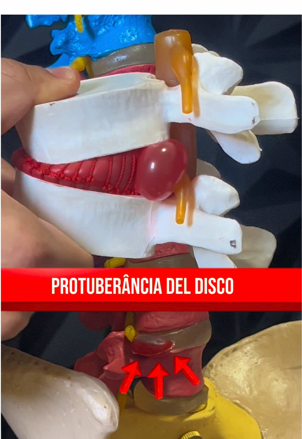 Hérnia de disco? - Como aliviar a dor na coluna! #dornascostas #ciatica #herniadedisco #dorlombar 