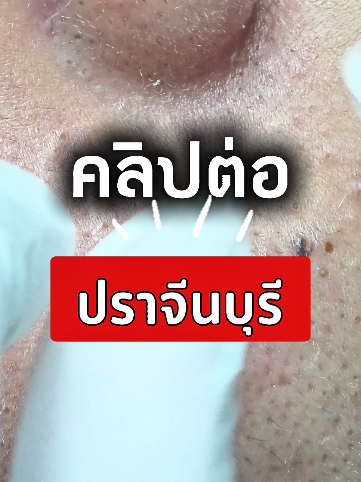 ต่อให้แล้วนะ อย่าลืมกดรักให้พี่มลด้วย❤️#พี่มลกดสิวโคราช #กดสิวโคราช #กดสิว #สิว #เทรนด์วันนี้ 